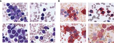 Pediatric non–Down’s syndrome acute megakaryoblastic leukemia patients in China: A single center's real-world analysis